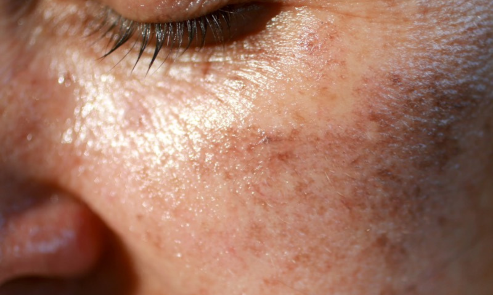 Treatments for Melasma