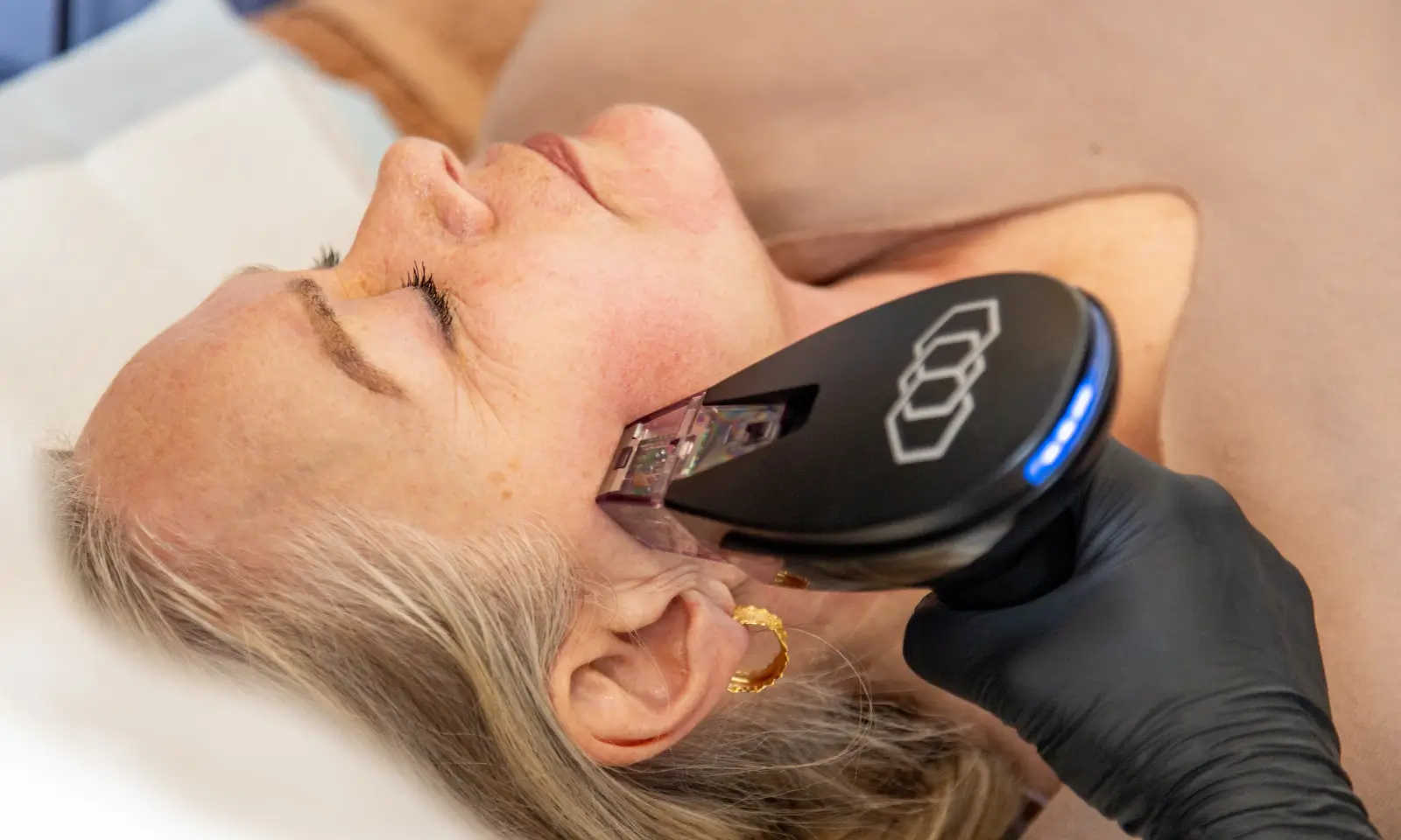 RF microneedling device shown for acne scar treatment education