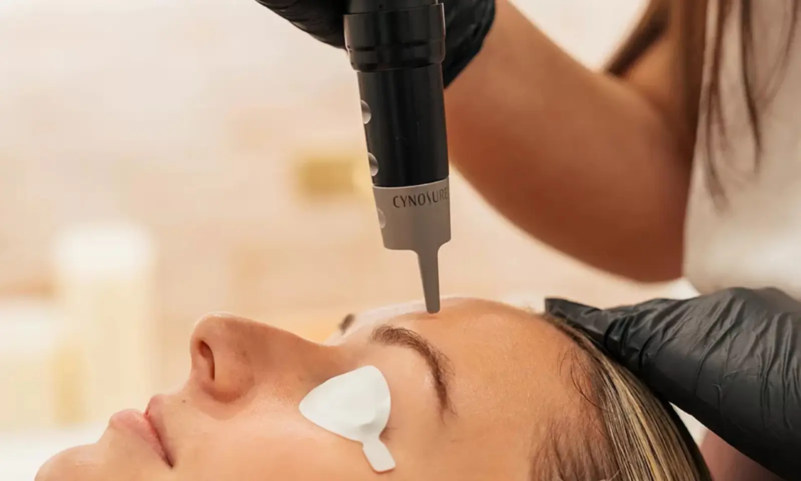 Laser device shown during a melasma management consultation